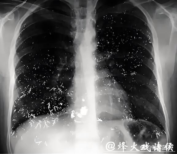 破羽绒服连穿四周，福州一男子确诊“羽绒肺”！医生提醒：严重或致呼吸衰竭！